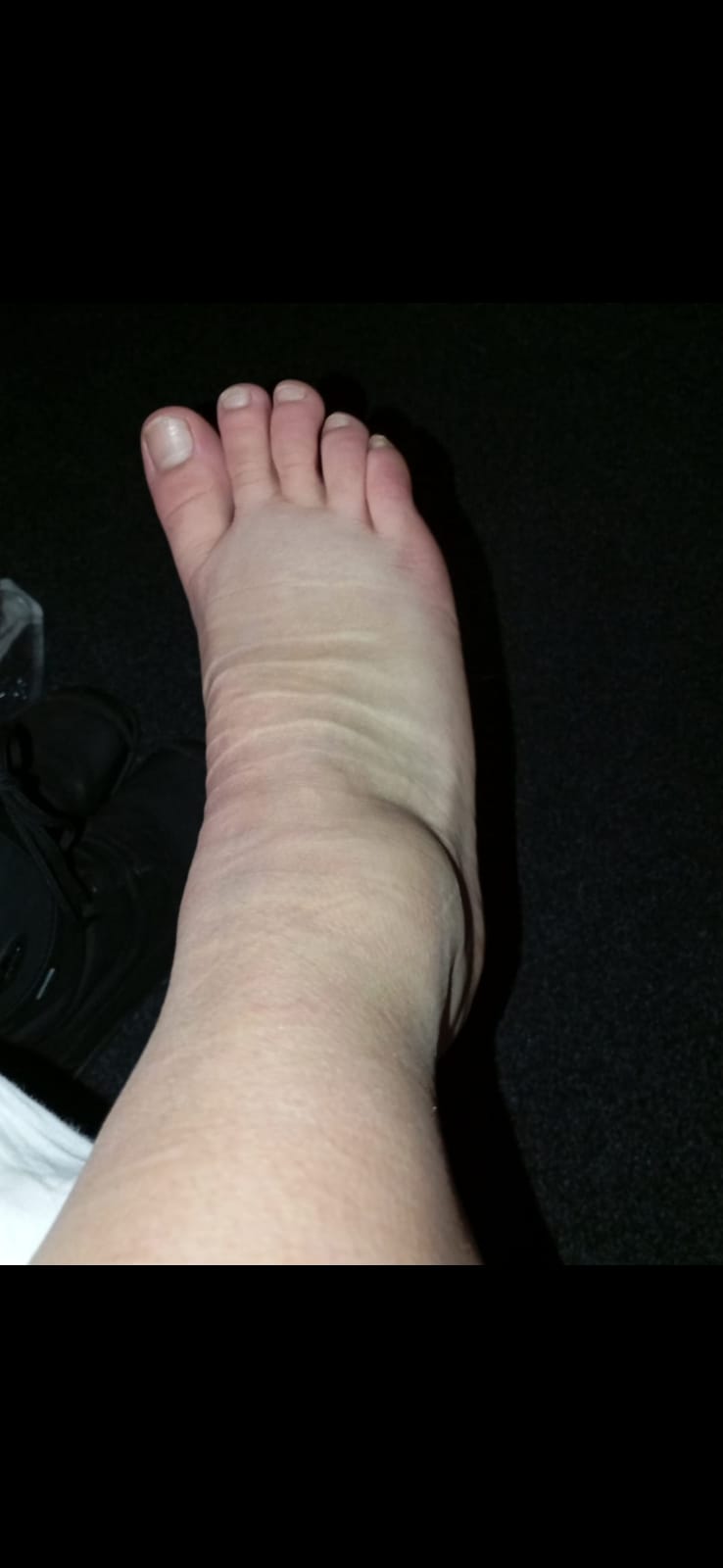 zranění nohy na lyžařském výcviku